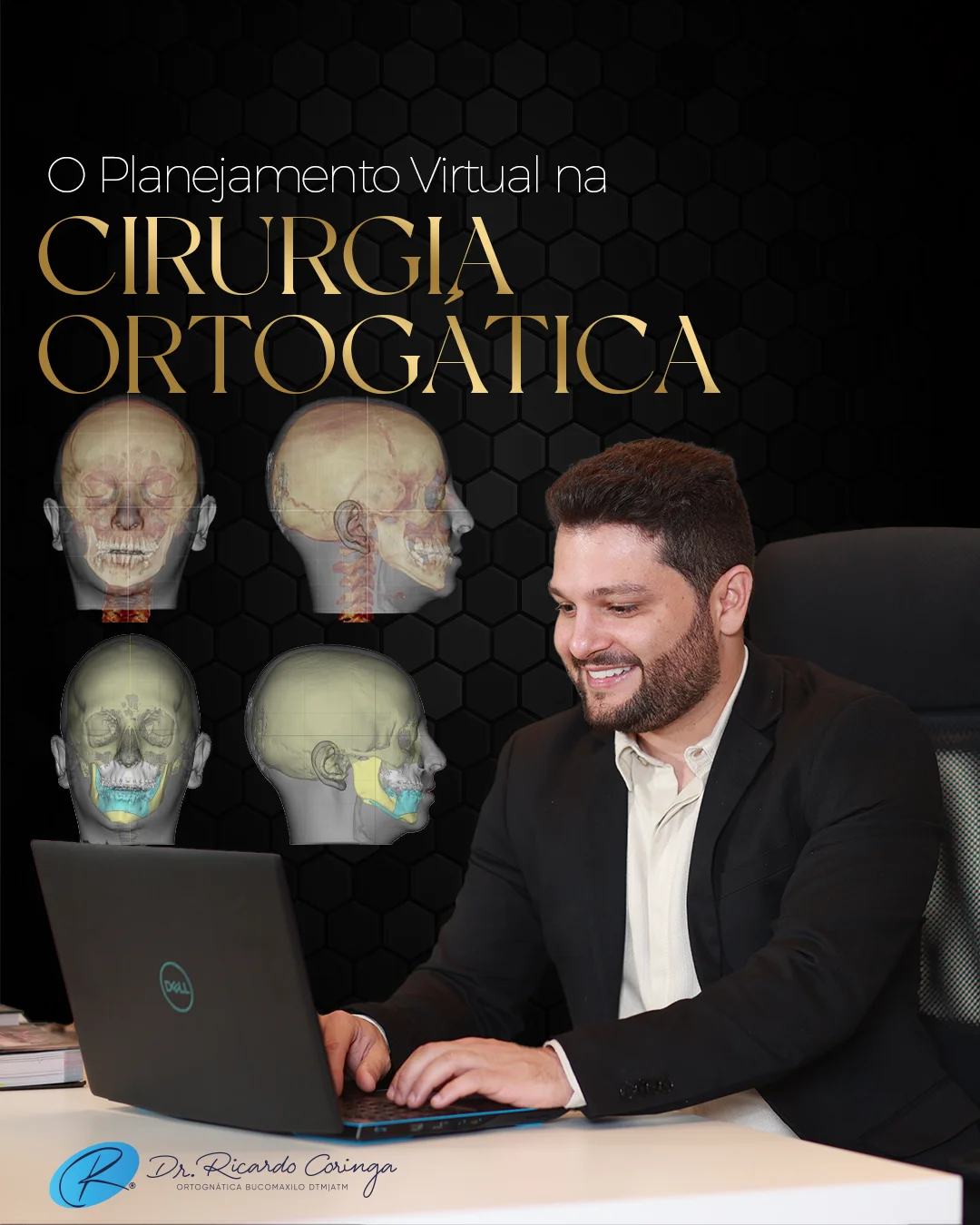 Cirurgia Ortognática: O papel do planejamento virtual 3D