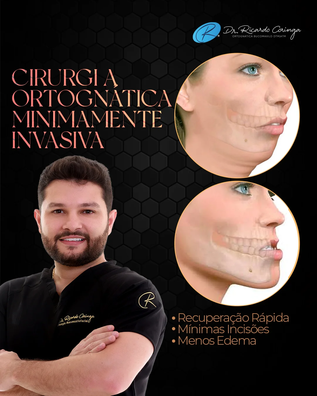 Cirurgia Ortognática Minimamente Invasiva: Mais Precisão, Menor Trauma e Recuperação Otimizada